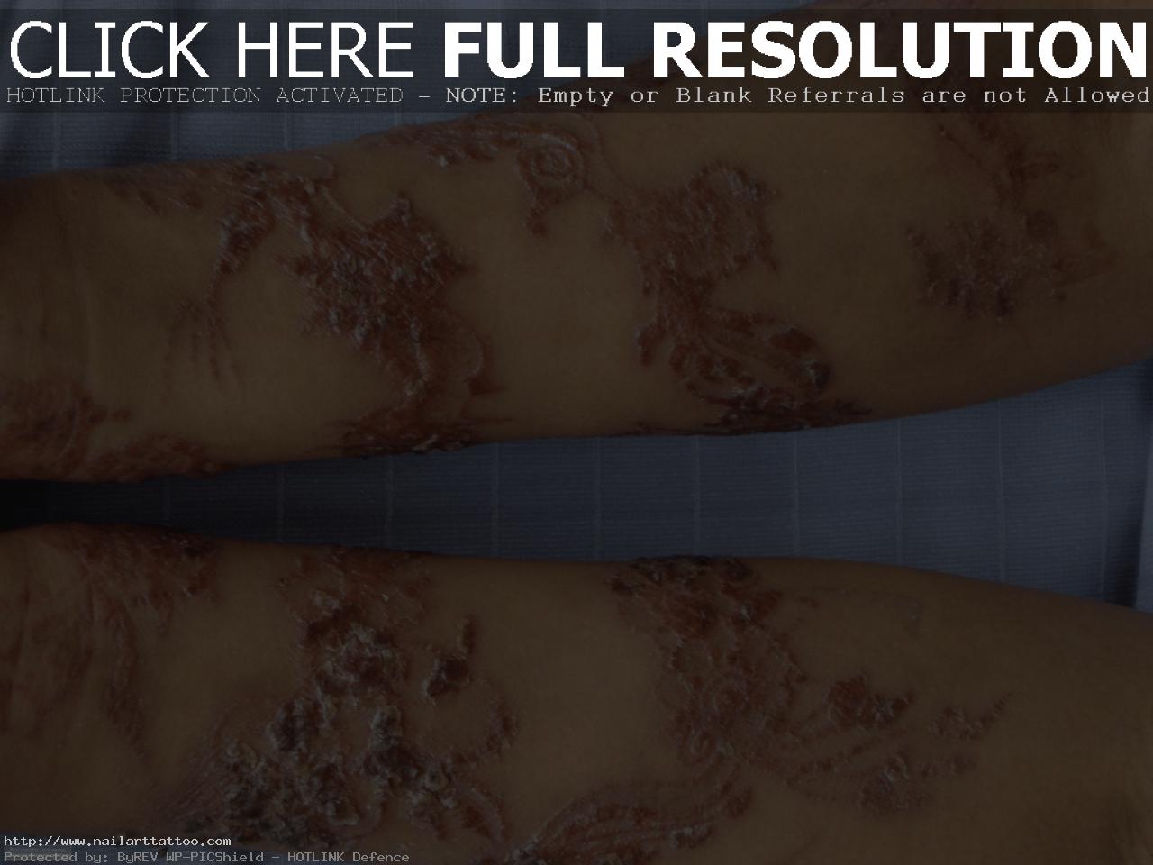 black henna tattoo scars